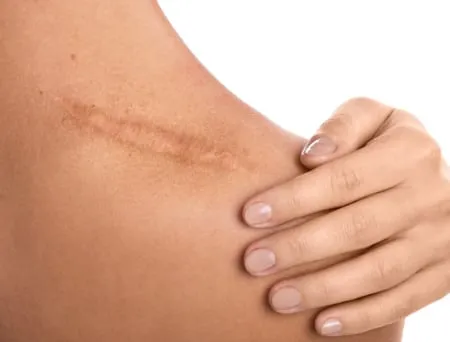 ScarWork™ and Restore Scar Therapy